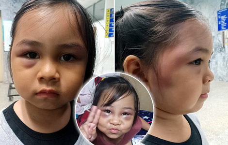 thai-little-girl-beaten-swelling-pattaya-school-teacher-mother-family-jaja